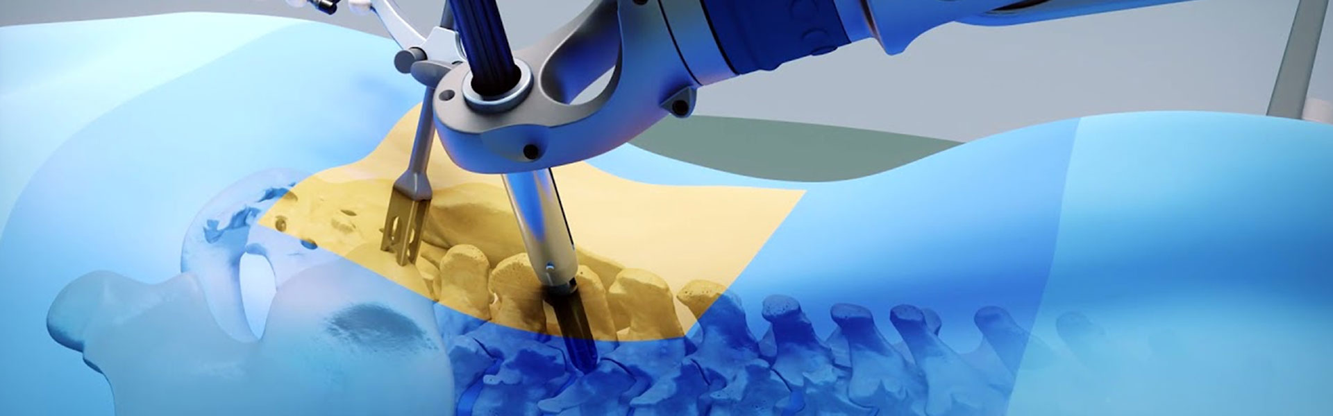 Minimally Invasive Spine Surgery